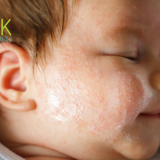 hard water skin Largo FL, dry itchy skin Largo, eczema water softener Largo, dermatologist Largo dry skin, Largo water quality skin damage, water softener skin improvement, itchy skin from shower Largo, soft water Largo reviews, best water softener Largo FL, Largo hard water solution