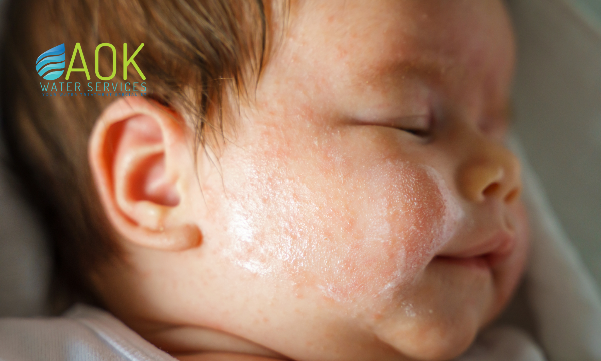 hard water skin Largo FL, dry itchy skin Largo, eczema water softener Largo, dermatologist Largo dry skin, Largo water quality skin damage, water softener skin improvement, itchy skin from shower Largo, soft water Largo reviews, best water softener Largo FL, Largo hard water solution