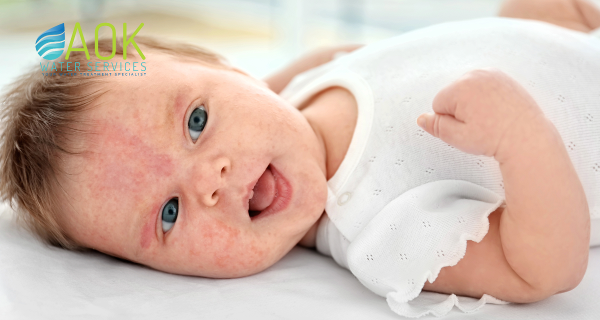 Why Is My Baby’s Eczema Getting Worse?
