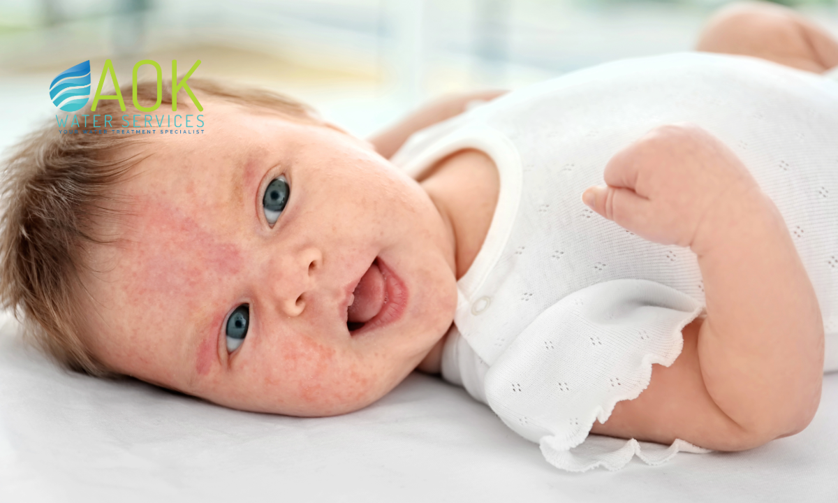 baby eczema Largo FL, eczema flare ups Largo, infant dry skin Largo, hard water skin irritation Largo, baby bath water Largo FL, Largo pediatric dermatology, water softener for baby skin, Largo FL water quality, hard water baby eczema, sensitive skin Largo babies, Largo eczema solutions, best water softener Largo, Largo parenting water issues, itchy baby skin Largo, water softener Largo FL reviews