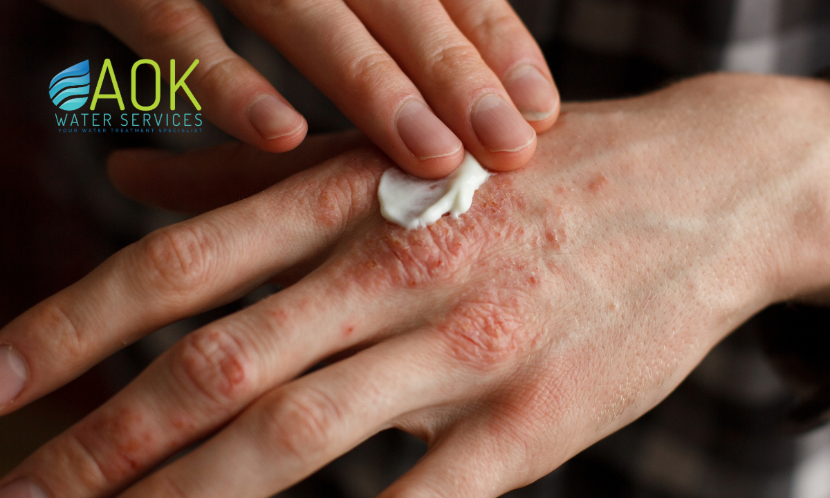 hard water Largo FL, skin irritation from tap water, Largo dry skin treatment, water softeners for skin Largo, eczema and hard water Largo, Largo water quality and skin, dry itchy skin Largo FL, how water softeners help skin, Largo skin barrier damage, shower skin dryness Largo FL